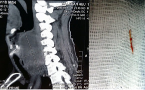 Hóc xương cá, người đàn ông ở Quảng Trị suýt mất mạng