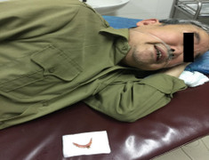 Uống thuốc, nuốt luôn cầu răng giả, bệnh nhân phải cấp cứu