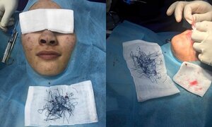 Mũi xanh lét sau khi phẫu thuật thẩm mỹ, bác sĩ gắp ra hàng trăm sợi chỉ nilon