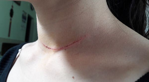 Mời khách vào quán ăn, thiếu nữ ở Hà Nội bị chém vào cổ