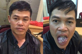 Khởi tố kẻ hiếp dâm bị cô gái cắn gần đứt lưỡi