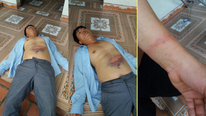 Dân tố bị công an đánh nhập viện vì hiểu nhầm lấy trộm xe