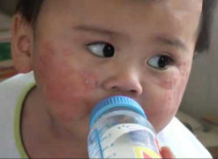 Cách nhận biết và chăm sóc trẻ mắc bệnh tay chân miệng