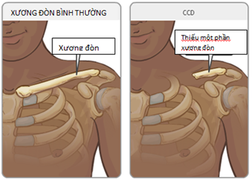 Cảnh báo chứng bệnh loạn sản xương đòn sọ hiếm gặp và nguy hiểm