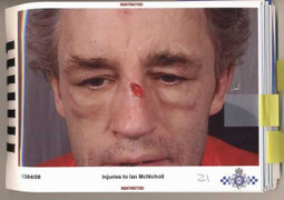 Từ chối quan hệ, doanh nhân bị bạn gái đánh nứt xương sọ, gãy xương sườn