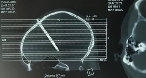 Báo Anh đưa tin bệnh nhân Việt không chịu đi khám dù đinh 8 cm xuyên vào đầu