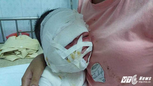Mẹ bất cẩn, con trai 11 tháng tuổi bị cả ấm nước sôi đổ xuống đầu