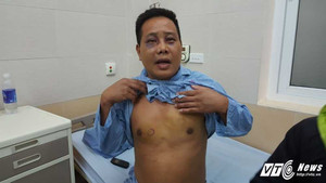 Uống cà phê với bạn gái, người đàn ông bị đánh chấn thương sọ não