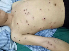 Đi lấy gỗ làm nhà, bị bắn 53 viên đạn hoa cải vào người