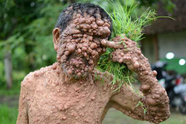 Những căn bệnh quái ác biến khuôn mặt người thành ‘quái vật’