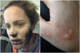 Tai nghe nổ trên đầu, nữ hành khách cháy đen mặt