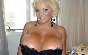 Người sở hữu bộ ngực lớn nhất thế giới buộc phải cắt bỏ