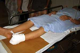 Dập nát bàn chân vì tai nạn lao động