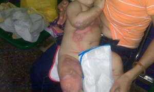 Bé 9 tháng bỏng nước sôi vì sự bất cẩn của người lớn