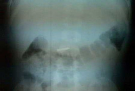 Cấp cứu bệnh nhi 9 tuổi nuốt chiếc nhẫn vào bụng