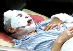 Ghen tuông, vợ đang tâm tạt axit vào chồng