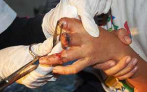 Một học sinh bị đứt lìa 3 ngón tay trong lớp