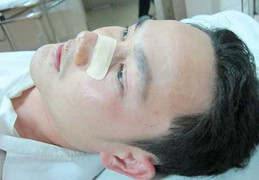 CSGT đập gãy xương mũi một thanh niên