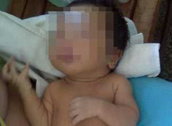 Vàng da bệnh lý: Bé 2 ngày tuổi phải thay máu