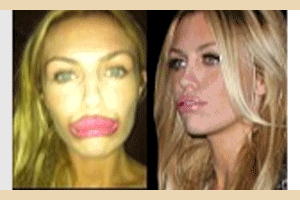 Abbey Crouch khoe môi sưng mọng vì 'dao kéo'