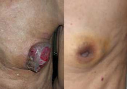 Ung thư vú ở nam giới: Chảy máu, rớt dịch