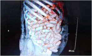 Lấy 2 kg cocain từ dạ dày