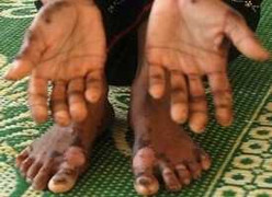 Bệnh lạ bùng phát