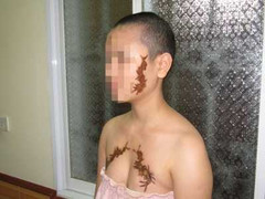 'Quái thú' trên mặt, ngực thiếu nữ nhiễm trùng