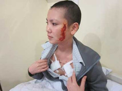 Việc trị 'quái thú' trên mặt thiếu nữ gặp khó khăn