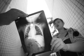 Bé gái 2 tuổi nuốt nhầm bao cao su