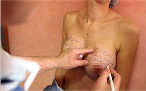 Nâng ngực chỗ không đảm bảo, dính túi PIP như chơi