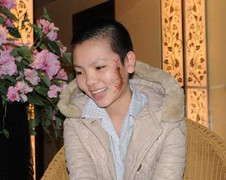 'Cô gái mặt rết' xinh xắn, rạng ngời ngày ra viện