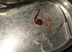 Gắp con đỉa gớm ghiếc trong khí quản bé gái 5 tuổi