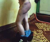 Hà Nội: Bé trai bị mẹ kế bạo hành nhiều ngày liền?