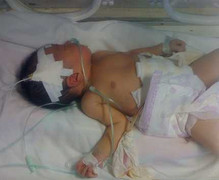 Tắc phân su: Trẻ 2 ngày tuổi bị thủng ruột