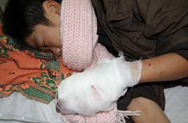 Nhét pháo vào túi quần, một học sinh nát tay