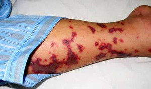 Cảnh báo dịch viêm não mô cầu quay lại