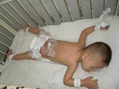 Ngã trúng nồi nước sôi, bé 7 tuổi bỏng nặng