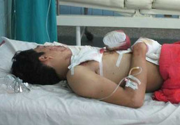 Chơi pháo, một thanh niên nguy kịch