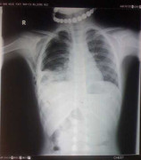 Bị trâu húc, cháu gái 7 tuổi nguy kịch