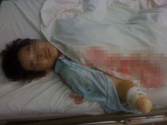 Mìn tự chế phát nổ, một thanh niên tàn phế suốt đời