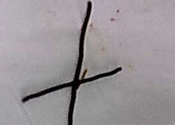 Nuốt chửng 2 sợi dây kẽm làm thủng ruột non