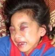 Bé gái 10 tuổi đau đớn vì bị bố mẹ hành hạ dã man