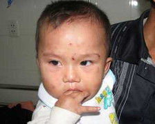 Bé 11 tháng tuổi bị ong đốt 100 nốt thoát chết thần kỳ