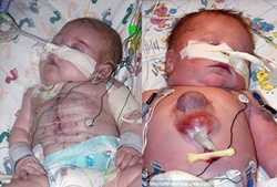 Lần đầu tiên trên thế giới:Bé có tim bên ngoài sống sót