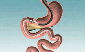 Thiết bị điện tử cấy vào dạ dày giúp giảm cân