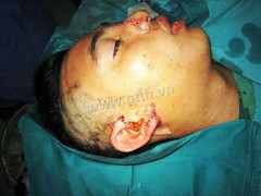 Nối thành công tai đứt rời do bị cắt