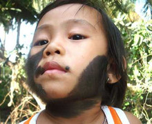 Một bé gái mọc đầy lông ở cổ