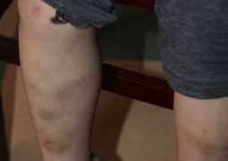 Đà Nẵng: Phụ huynh 'tố' giáo viên mầm non đánh con