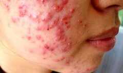 Dân văn phòng: Mụn mọc chi chít do… ngồi nhiều